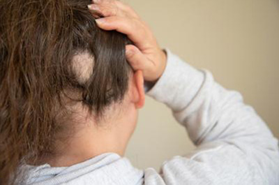 FAQs About Alopecia