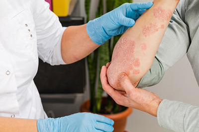 Eczema vs. Psoriasis: Understanding the Differences