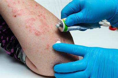 Treating Your Psoriasis