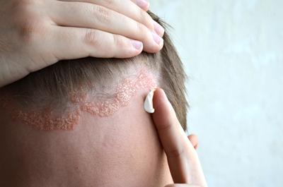 Treatment Options for Psoriasis