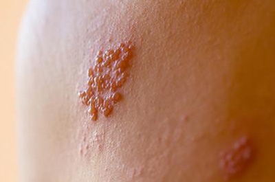 What to Know About Shingles