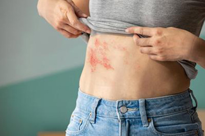 What To Know About Shingles