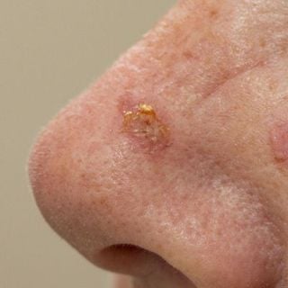 Actinic Keratoses