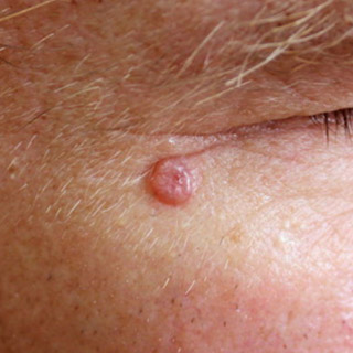 Basal Cell Carcinoma