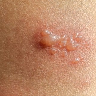 Bullous Pemphigoid