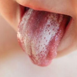 Candidiasis