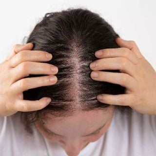 Female Pattern Hair Loss (Androgenetic Alopecia)