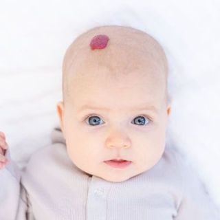 Infantile Hemangiomas