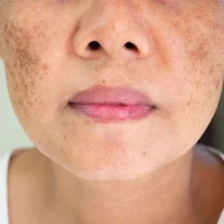 Melasma