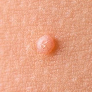 Molluscum Contagiosum