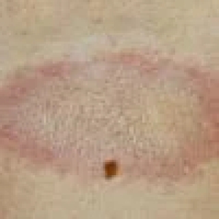 Morphea (Localized Scleroderma)