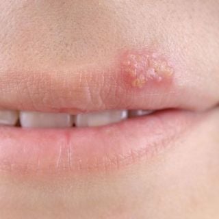 Oral Herpes (Herpes Simplex Labialis, Cold Sores, Fever Blisters)