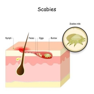 Scabies