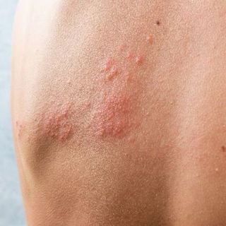 Shingles (Herpes Zoster)