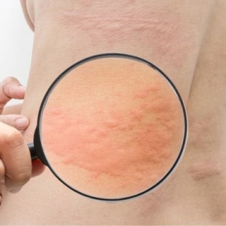 Urticaria (Hives)